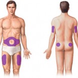 Locuri injectare insulina Locuri injectare insulina