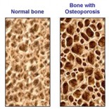 os normal si cu osteoporoza