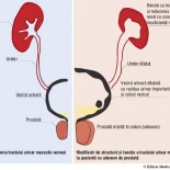 adenomul_de_prostata2 adenomul_de_prostata2