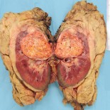 cancer renal cancer renal