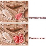 cancer de prostata