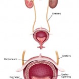 tract urinar litiaza urinara calculi