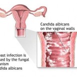 Candidoza_vaginala