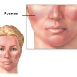 Acneea_rozacee_bendo Acneea_rozacee_bendo