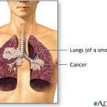 cancer de plaman - cancer pulmonar