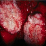 cancer pulmonar cancer pulmonar