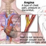 angina pectorala durere in piept angina pectorala durere in piept