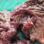 cancer gastric cancer gastric