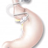 inel gastric inel gastric