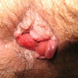 tratament medical hemoroizi