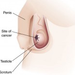 cancer testicular