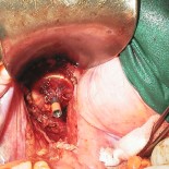 tratament chirurgical rect tratament chirurgical rect