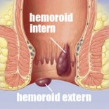 hemoroizi interni si externi hemoroizi interni si externi