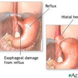 mecanismul refluxului si schema herniei hiatale-cauza de reflux mecanismul refluxului si schema herniei hiatale-cauza de reflux