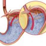 reflux esofagian reflux esofagian
