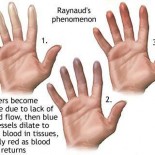 sindromul raynaud sindromul raynaud