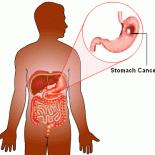 cancer gastric cancer gastric