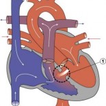 defect septal ventricular