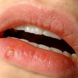 herpes bucal