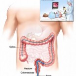 colonoscopie totala