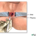 fisura anala fisura anala