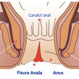 fisura_anala_remedii fisura_anala_remedii