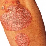 psoriazis psoriazis