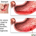 ulcer gastric ulcer gastric