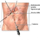 Colecistectomie laparoscopica Colecistectomie laparoscopica