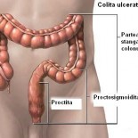 rectocolita hemoragica rectocolita hemoragica