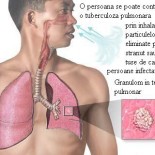 tbc pulmonar transmitere tbc pulmonar transmitere