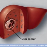 cancer de ficat - hepatocarcinom cancer de ficat - hepatocarcinom