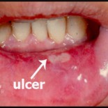 ulcer bucal gura