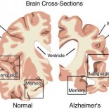 alzheimer creier