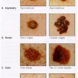 cancer piele benign spre malign cancer piele benign spre malign