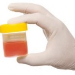 hematuria