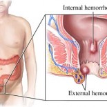 hemoroizi tratament sclerozant hemoroizi tratament sclerozant