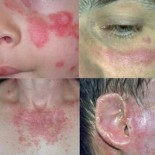 lupus discoid lupus discoid