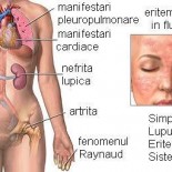 lupus poze