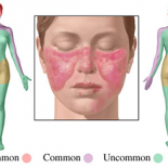 lupus poze2 lupus poze2