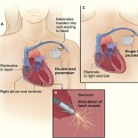 pacemaker poze pacemaker poze