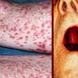 purpura trombocitopenica