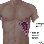 splina marita splenomegalie splina marita splenomegalie