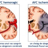 avc hemoragic
