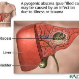 abces hepatic abces hepatic