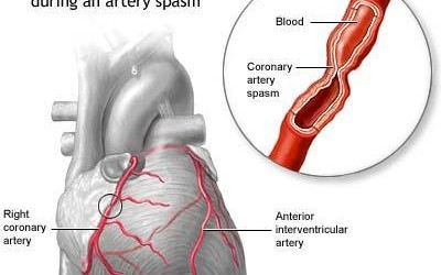 angina pectorala prinzmetal