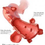 diverticuloza diverticuloza