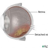 retina dezlipita 1