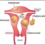 fibrom uterin