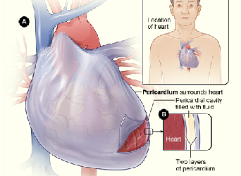 pericardita